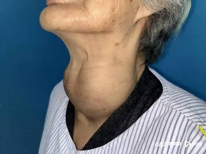 身体有癌，脖子先知？脖子上出现3种迹象，可能是癌症来临的预警