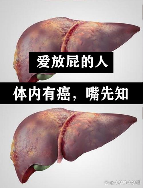 体内有癌，肛门先知？肛门若常有这6点不适，可能是癌症在靠近